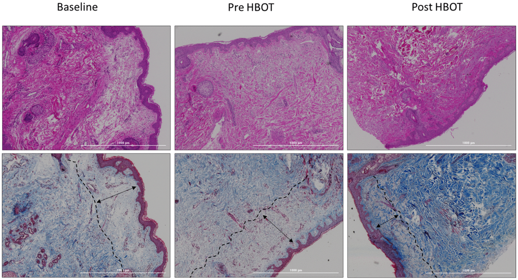 Papillary layer thickness changes. Following HBOT, there was a significant decrease in the papillary layer thickness.