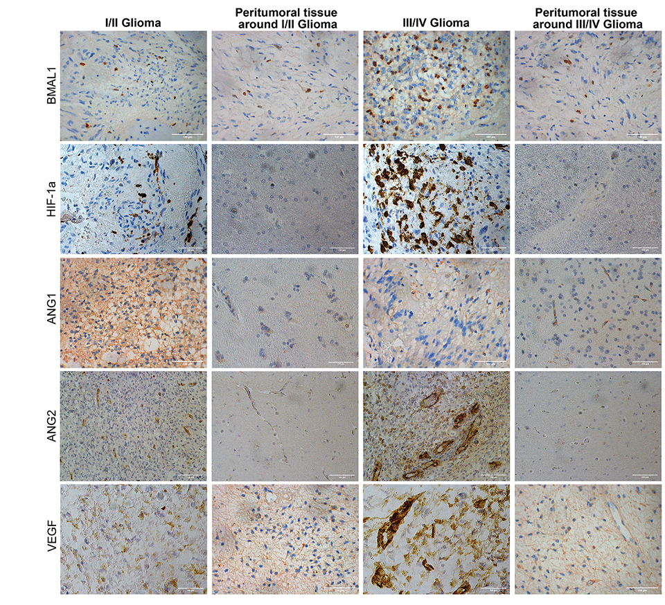 Immunohistochemistry analysis of BMAL1, HIF-1a, ANG1, ANG2, and VEGF expression in glioma and normal tissues with different pathological grades.