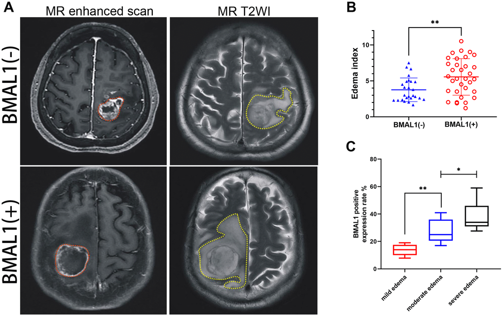 MR images of clinical patients showed the relationship between peritumoral brain edema and BMAL1 expression. (A) A set of representative graphs displaying MR images of brain edema. The red dotted line is the solid part of the tumor, and the yellow dotted line is the area of brain edema around the tumor. Patients with BMAL1 (+) had obvious peritumoral edema. (B) The EI was compared between the BAML1 (+) expression group (n = 59) and the BAML1 (−) expression group (n = 20). (C) BMAL1 expression levels in the mild edema group (n = 5), moderate edema group (n = 15), and severe edema group (n = 39) were assessed. *p **p ***p 