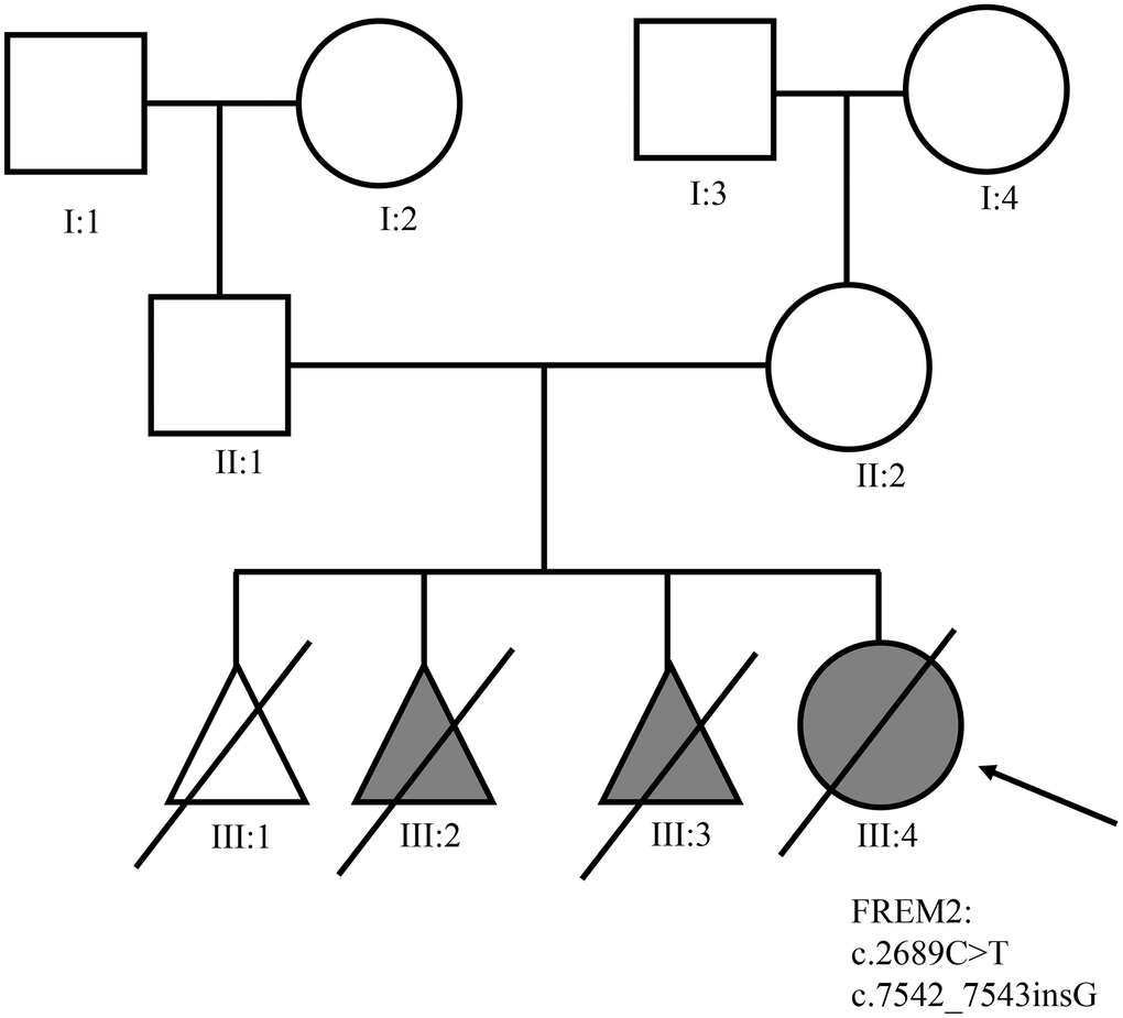 The pedigree of the family with Fraser syndrome. Roman numerals indicate generations, and individuals within a generation are numbered from left to right. The proband (III: 4) is denoted with an arrow.