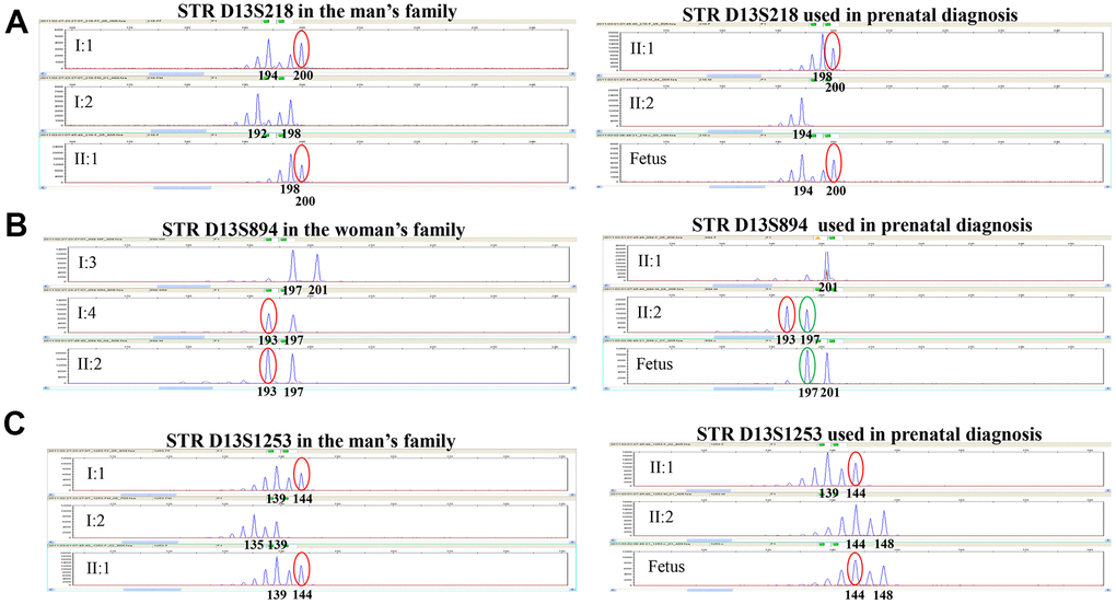 Genotyping results of STR D13S218, STR D13S894, and STR D13S1253 in this family. STR D13S218, D13S894 and D13S1253 showed that the fetus was a heterozygous carrier with one FREM2 gene mutation (c.2689C>T, p.Gln897Ter) inherited from the father, which is consistent with the PGD result. (A) Genotyping for STR D13S218 in the man’s family and used in prenatal diagnosis indicates that the chromosome carrying pathogenic mutation originated from his father. The fetus inherited pathogenic chromosome from his father. (B) Genotyping for STR D13S894 in the woman’s family and used in prenatal diagnosis indicates that the chromosome carrying pathogenic mutation originated from her mother. The fetus inherited the normal chromosome from his mother. (C) Genotyping for STR D13S1253 in the man’s family and used in prenatal diagnosis indicates that the chromosome carrying pathogenic mutation originated from his father. The fetus inherited the pathogenic chromosome from his father.