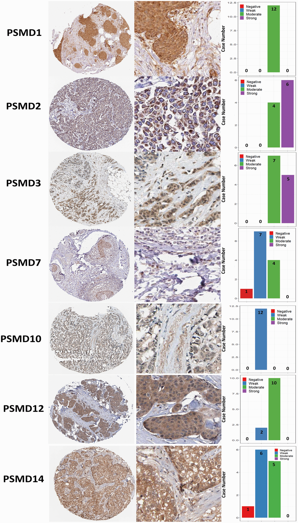 Immunohistochemical staining of 26S proteasome delta subunit, non-ATPase (PSMD) family members in normal tissues and breast cancer (BRCA) tissues represented in IHC staining images and bar chart. The images illustrate intensities of antibodies in both BRCA and adjacent normal tissues while the bar charts of IHC staining show intensities of PSMD family members in BRCA.