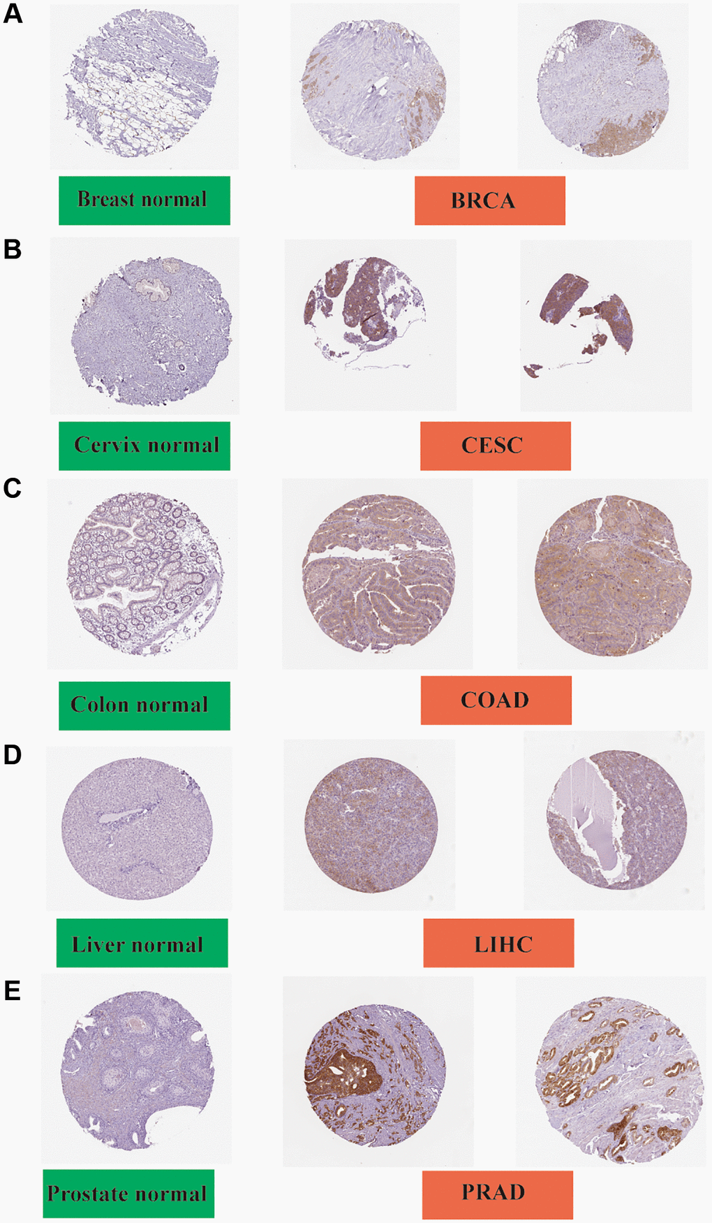 Immunohistochemistry slides of normal (left) and tumor (middle and right) tissues. FASN protein expression was significantly higher in BRCA, CESC, COAD LIHC, and PRAD. (A) Breast; (B) Cervix; (C) Colon; (D) Liver; and (E) Prostate.