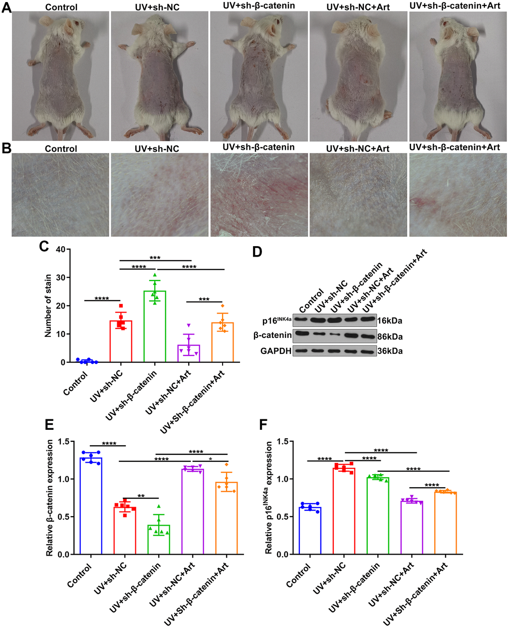 The effects of Art treatment and silencing β-catenin expression on UVB-irradiated skin photoaging of mice. (A, B) Clinical and dermoscopic observations of the back skin of mice in control group, UV + sh-NC group, UV + sh-β-catenin group, UV + sh-NC + Art group and UV + sh-β-catenin + Art group. (C) Quantification of the number of stains in skin tissue of mice from each group. (D–F) Western blot of the expression of β-catenin and p16INK4a in skin tissues of mice. *p