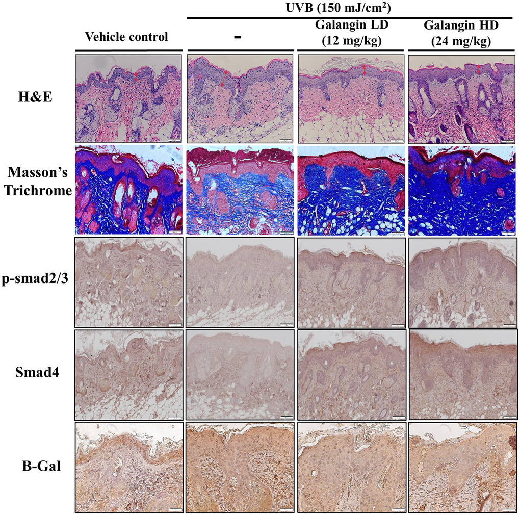 Topical galangin application attenuates UVB-induced skin hyperplasia and collagen degradation in the dorsal skin of C57BL6/J nude mice. Skin tissues were serially sectioned and stained with H&E, Masson’s trichrome, and immunohistochemically for p-Smad2/3 Smad4 and β-gal. H&E staining showed epidermal thickness. Double-headed red arrows indicate the epidermal thickening. Masson’s trichrome staining showed the collagen fiber content in dermal layers. Collagen fibers appear blue. LD, low dose; HD, high dose.