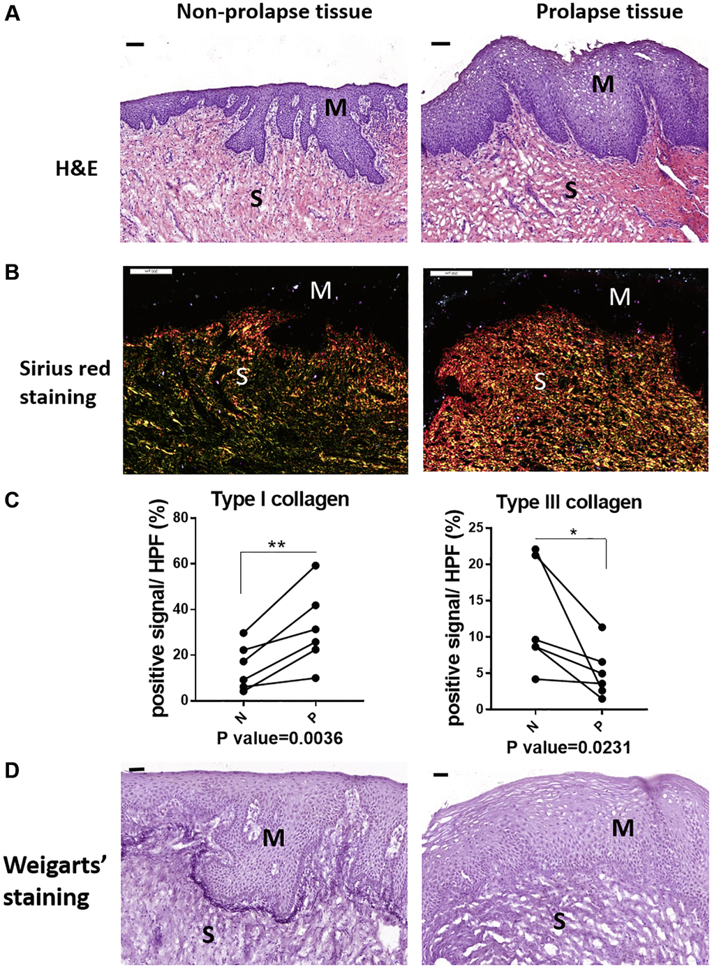 The micro-structural changes in vagina tissue of pelvic organ prolapsed patients. (A) HE staining revealed obvious microstructure porosity and disappeared Vicious Angle structure in the prolapsed tissue (M: mucous layer, S: submucosa layer. scale bar 100 um), (B) Sirius red staining showed increased type I collagen and decreased type III collagen in the prolapsed tissue (type I collagen was red and bright yellow, type III collagen was green, scale bar 200 um), (C) Sirius red staining as in B was quantified, the proportion of positive signals area (red signals for type I collage and green signals for type III collagen) in each High Power Field of vision (HPF) were quantified, n = 6 in each group. (D) Weigarts’ staining demonstrated disappeared elastic fibers near basal layer in the prolapsed tissue (scale bar 50 um).