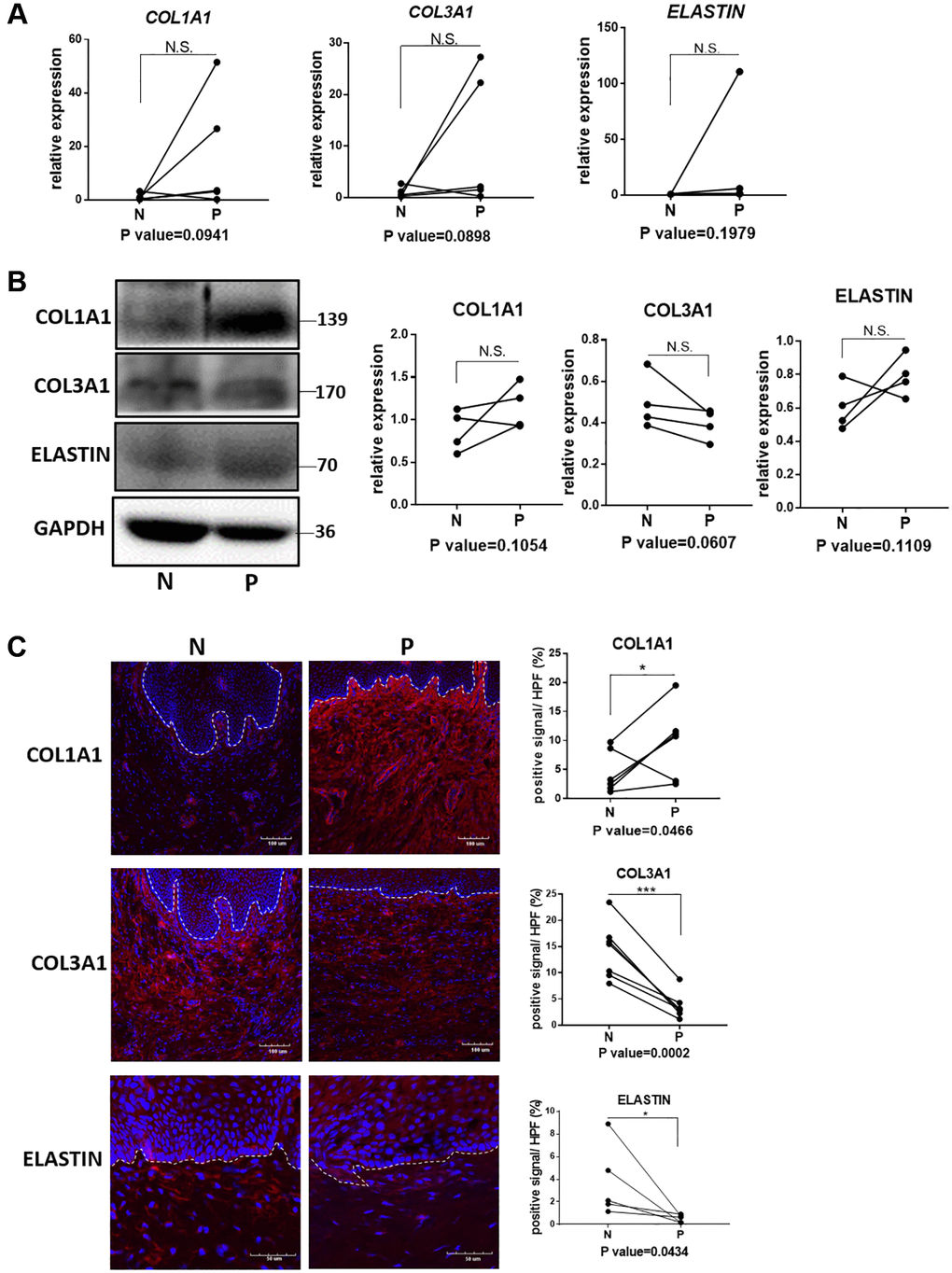 Quantification analyses of type I collagen, type III collagen and elastin in vagina tissue of pelvic organ prolapsed patients. (A) qRT-PCR analyses showed mRNA expression level of COL1A1, COL3A1 and ELASTIN in vagina tissue (N: non-prolapsed tissue, P: prolapsed tissue, n = 4 in each group). (B) Western blots analyses of COL1A1, COL3A1 and ELASTIN in vagina tissue. Relative content of each protein were quantified on the right, the levels of protein expressed relative to GAPDH, (n = 4 in each group). (C) Immunofluorescence staining for visualization (red) of COL1A1, COL3A1 and ELASTIN in vagina tissue (White dotted line indicated the interface between mucus layer and submucosa layer). The proportion of positive signal area (red) in each High Power Field of vision (HPF) of each protein were quantified on the right, (n = 6 in each group).