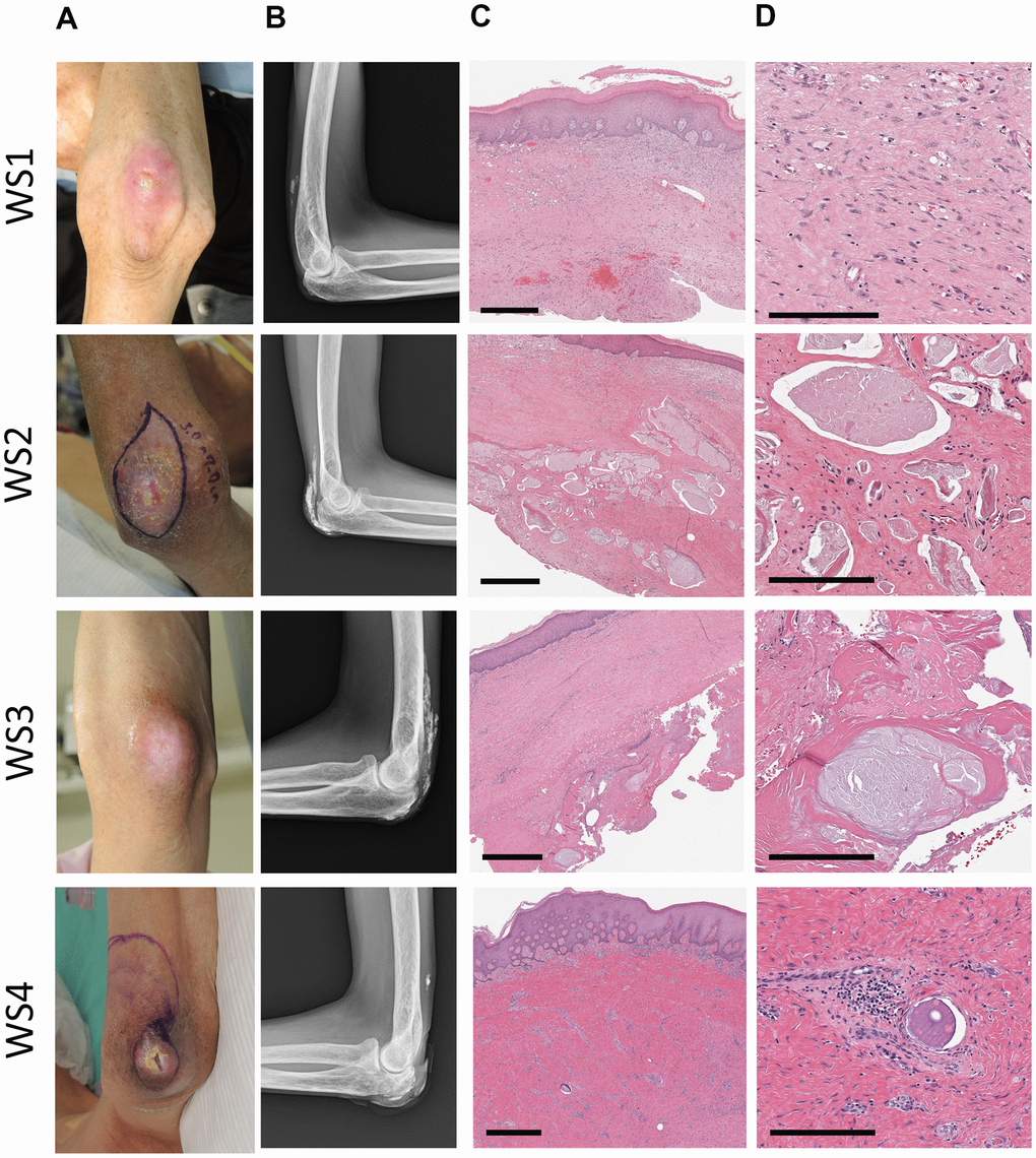 Clinical images of patients. A series of photographs (A) of elbow ulcers in four patients with Werner's syndrome (WS1-4), radiographs (B) of the same area, and HE stained tissue (C, D) of the skin around the ulcers. WS1: 62-year-old male, WS2: 48-year-old male, WS3: 50-year-old female, WS4: 57-year-old male. (A) The skin around the ulcer is sclerotic and atrophic. (B) Various degrees of calcification were observed in the soft tissues around the elbow joint. In WS2 and WS3, it becomes a shadow of the flame state. (C, D) Strong fibrosis of the dermis (all cases) and calcification within the luminal structures (WS2, 3, 4). Scale bars are 700 μm (C) and 200 μm (D).