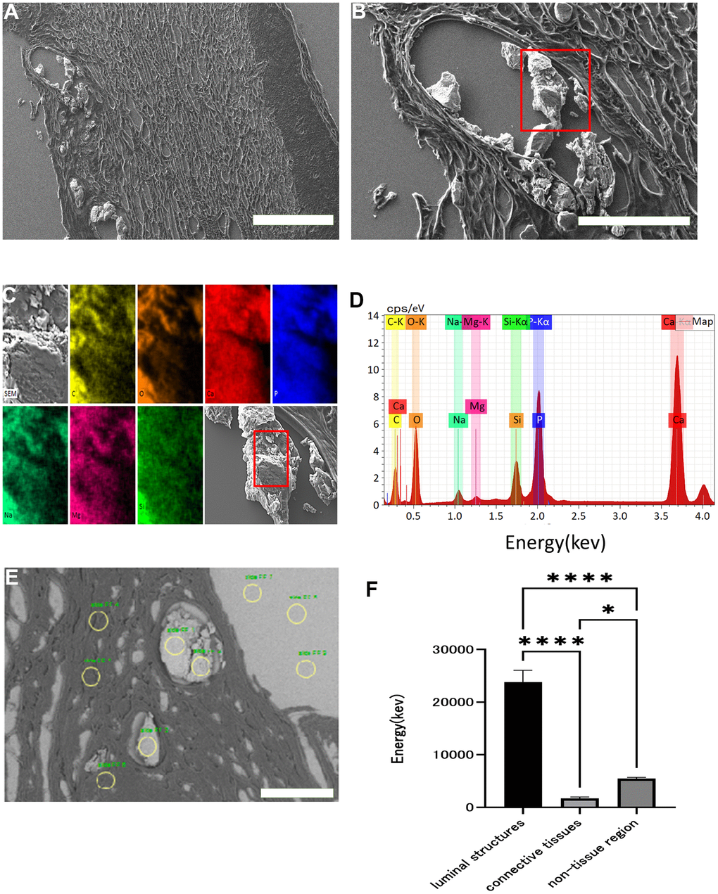 Scanning electron microscopy images and EDX analysis. Scanning electron micrograph of skin around an ulcer on a patient's elbow with WS (A: x 60, B: x 200). Crystalline substance in luminal structures under the dermis (red squares). This crystalline substance was examined with energy dispersive X-ray (EDX) (C, D). Each color and element combination corresponds to C for yellow, O for orange, Na for light blue, Mg for pink, Si for green, P for blue, and Ca for red. Using EDX, we measured the calcium content of the luminal structure, dermal connective tissue, and non-tissue areas at three points in each area (yellow circles), and performed similar measurements in three fields (E). Comparison of the calcium content of the luminal structure, dermal connective tissue, and non-tissue areas (F). Data are expressed as mean ± standard error. One-way ANOVA followed by Tukey test were performed (* p 