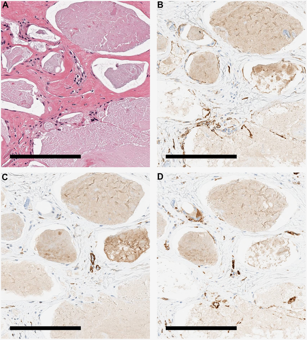 Immunohistochemical staining image of the patient's skin. Various stained tissue images of calcified tissues from a patient with WS. (A) HE. (B) Immunohistochemical staining with podoplanin antibody. Cells around the calcification were positive. (C) Immunohistochemical staining with αSMA antibody. Cells around the calcification were negative. (D) Immunohistochemical staining with CD 31 antibody. The cells around the calcification were weakly positive. All scale bars are 200 μm.