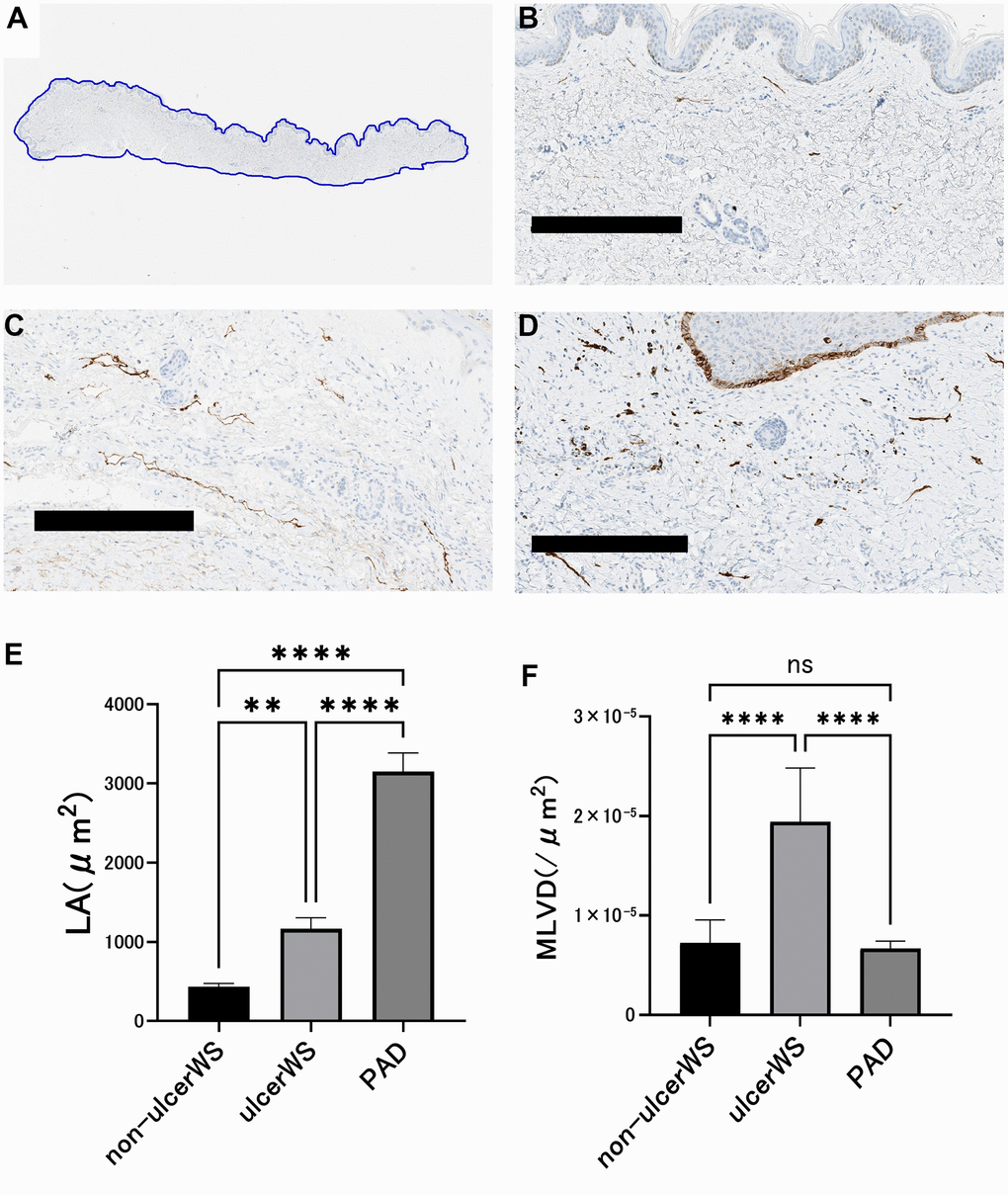 Image analysis of lymphatic vessels in the skin of patients. (A) The area of skin tissue sections was measured by tracing the skin margins using an Aperio Image Scope. (B) A representative example of skin histology taken from an ulcer-free area in a patient with Werner syndrome. Scale bar is 300 μm. The lumen is narrow and small in number. (C) A representative example of skin tissue taken from the ulcer circumference of a patient with PAD. Scale bar is 300 μm. The lumen is dilated and lined up. (D) A representative example of skin tissue taken from the ulcer circumference of a Werner syndrome patient. Scale bar is 300 μm. The lumen is indistinct and randomly proliferating. (E) Comparison of luminal cross-sectional area (LA) of the lymphatic vessels. In four patients with Werner syndrome, two different sites were measured in the non-ulcerated area and in the skin surrounding the ulcer. Three patients with PAD underwent measurements at two different sites of skin around the ulcer. Data are expressed as mean ± standard error. One-way ANOVA followed by Tukey test were performed (* * p F) Comparison of lymphatic vessel density (MLVD). In four patients with Werner syndrome, two different sites were measured in the non-ulcerated area and in the ulcer's skin. Three patients with PAD underwent measurements at two different sites of skin around the ulcer. Data are expressed as mean ± standard error. One-way ANOVA followed by Tukey test were performed (n.s. No significant difference, **** p 