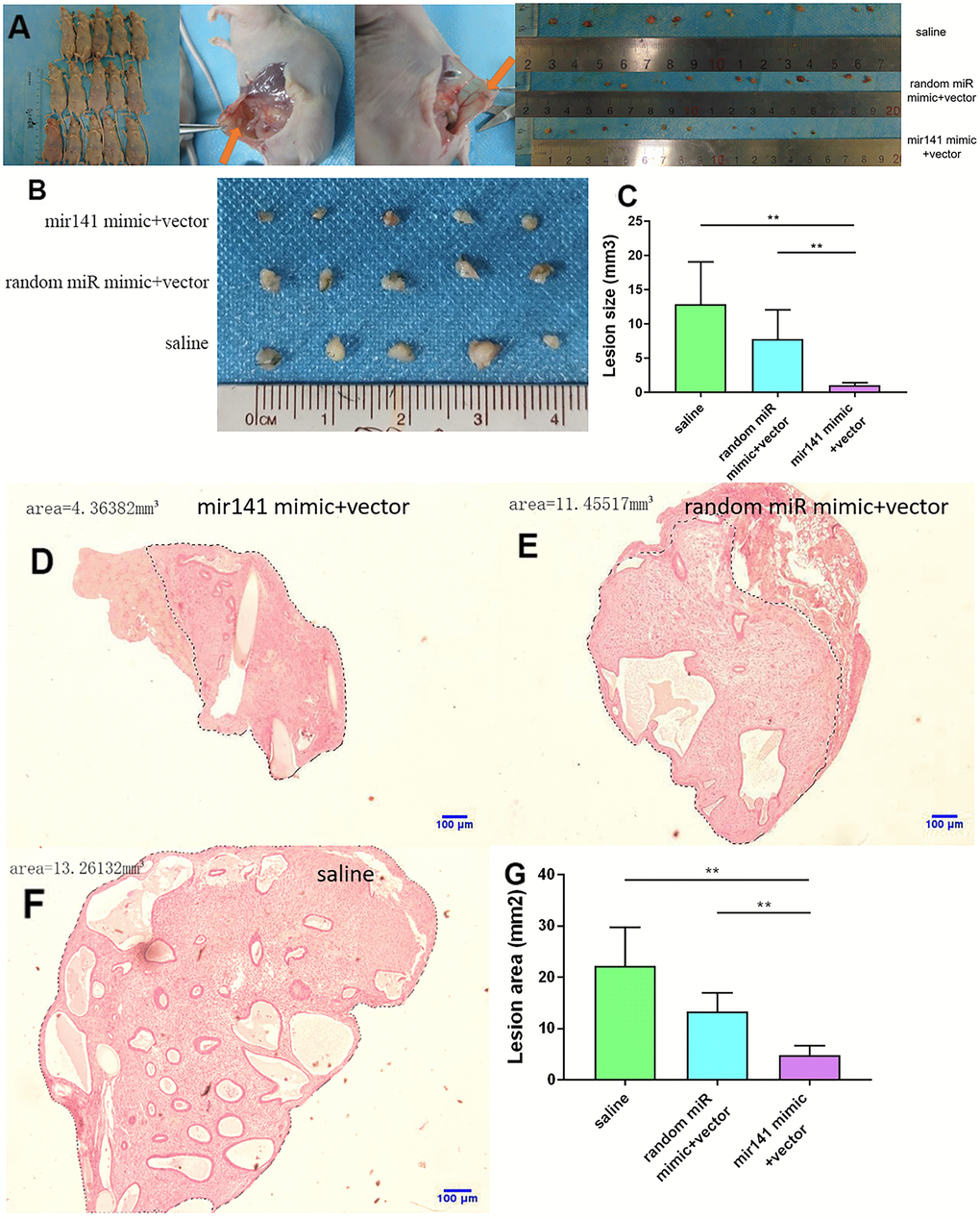 Collection and comparison of lesion tissues from each mouse. (A) The collection of endometriosis lesions. (B, C) Comparison of left abdominal lesion volume; (5 mice in each group). (D–G) The difference of histological area of the median section of endometriosis in mice of the upregulated group and control group under H&E staining (*P 