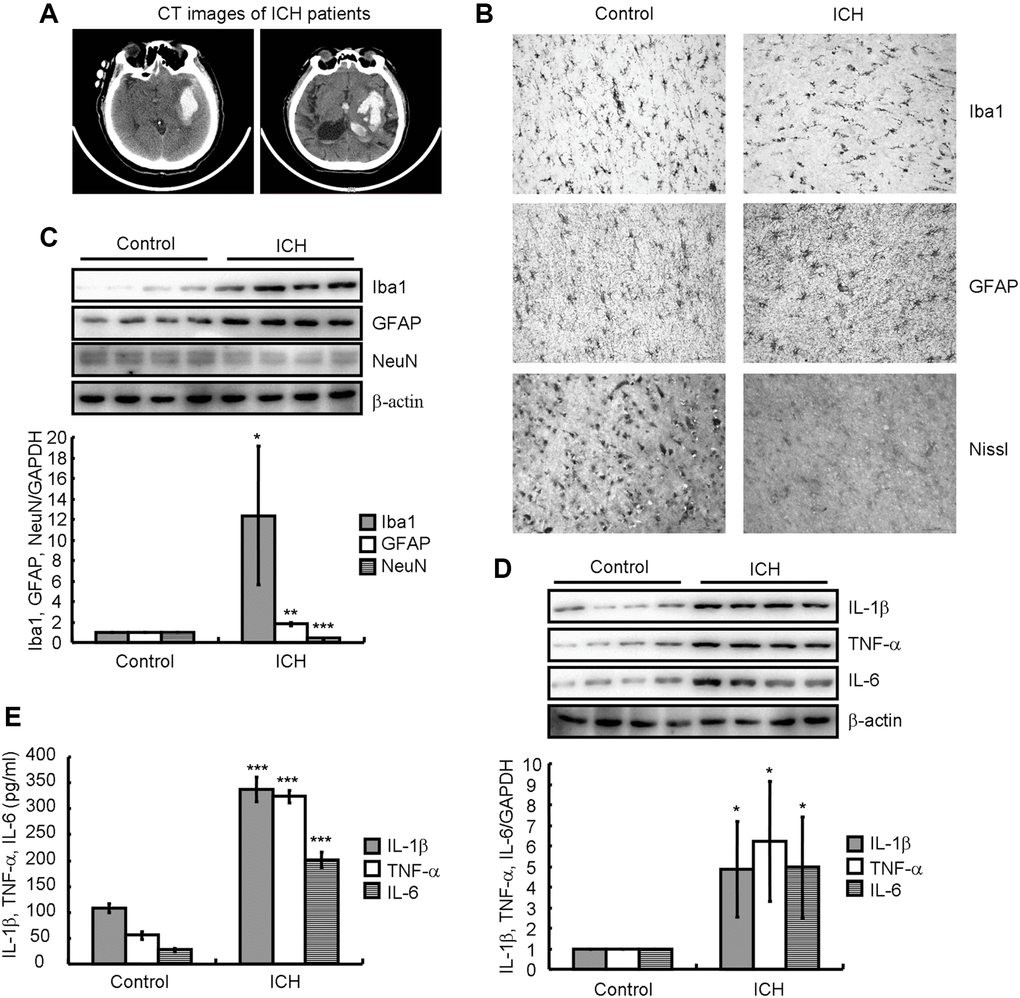 Neuroinflammation and neuronal loss were present in ICH patients. (A) A computed tomography (CT) image indicates hematoma formation in an ICH patient compared to a control subject. (B) Paraffin slices immunostained for Iba1 or GFAP show microglia and astrocytes, respectively. The morphology of neurons is revealed by Nissl staining. (C, D) Western blotting detects the protein expression of Iba1, GFAP, NeuN, IL-1β, TNF-α, and IL-6 in a patient with ICH. GAPDH serves as an internal control. (E) Concentrations of IL-1β, TNF-α, and IL-6 in the brain tissues of ICH patients were detected by ELISA. The results represent the mean ± SD for the repeated experiments. *P **P ***P 