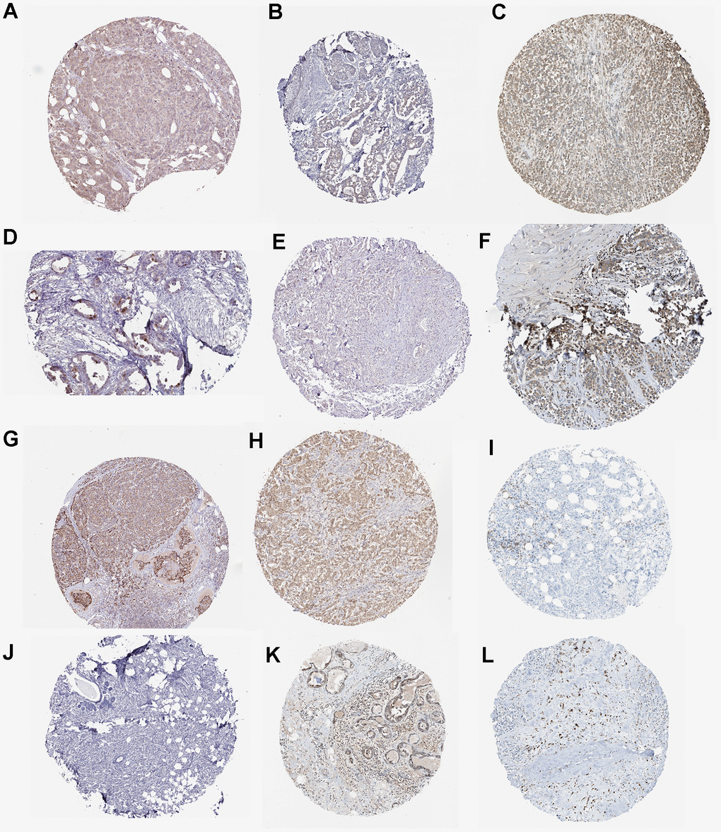 Immunohistochemistry for (A) DTX1 (https://www.proteinatlas.org/ENSG00000135144-DTX1/pathology/breast+cancer#imid