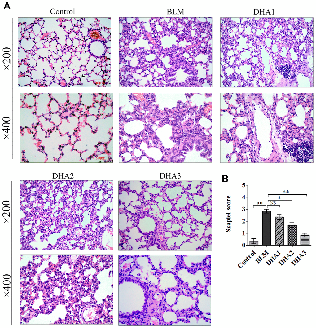 DHA attenuates early alveolar inflammation in a bleomycin-induced rat pulmonary fibrosis model. At 7 days after bleomycin intratracheal administration, with or without DHA treatment, the rats were sacrificed, and their lungs and blood were removed. (A) H&E staining was used to detect the lung histopathological changes and (B) Lung inflammation was scored (n = 6). *P **P 