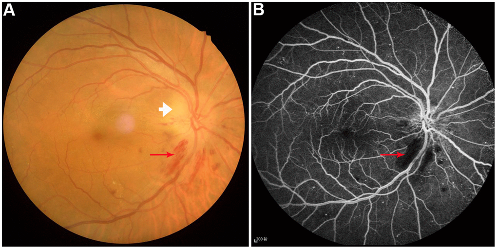 Example of diabetic optic neuropathy was performed on fundus camera (A) and fluorescence fundus angiography (B). Perioptic nerve hemorrhage (red arrow) and optic disc edema (white arrow) were observed.