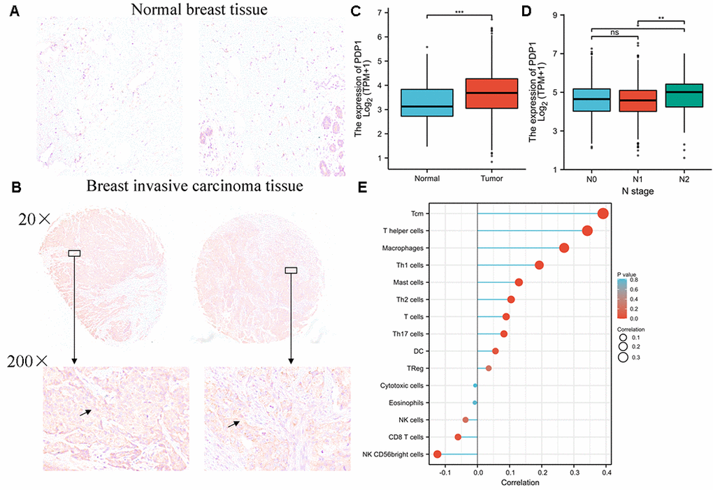 PDP1 was up-regulated in breast invasive carcinoma. (A) The level of PDP1 in normal tissues (n = 20) and (B) breast invasive carcinoma tissues (n = 70) was evaluated by immunohistochemical staining. The magnification is 100×. (C) The expression of PDP1 in BRCA tissues and normal tissues was analyzed by the cancer genome atlas (TCGA)-BRCA database. (D) The relationship between PDP1 expression and clinical N stage of breast cancer. (E) The relationship between PDP1 expression and breast cancer immune cell infiltration.