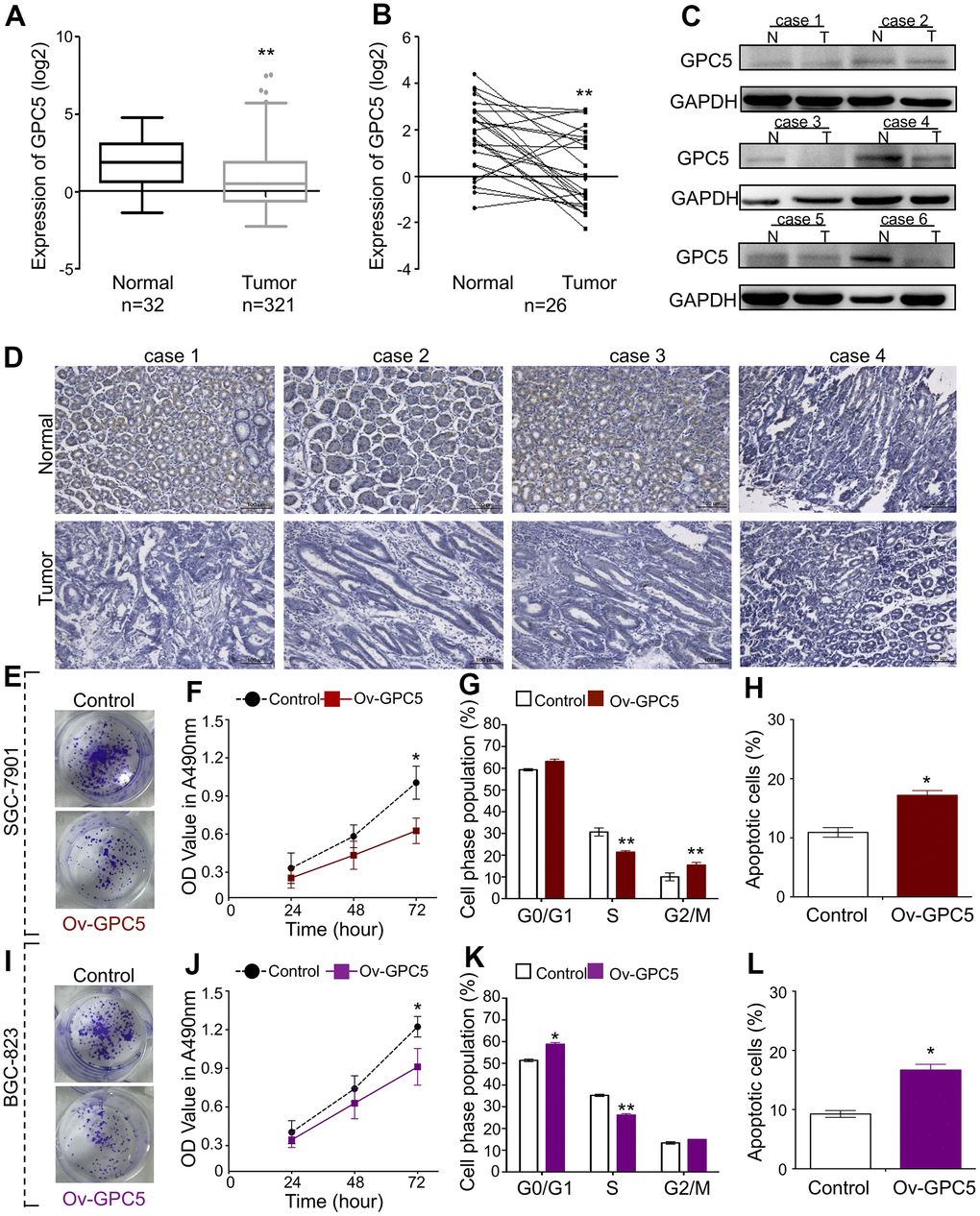 GPC5 suppresses GC cell proliferation and induces apoptosis. (A, B) Expression levels of GPC5 in GC tissues and their paired normal tissues according to the TCGA database. (C, D) Protein expression of GPC5 was measured by western blot and immunohistochemistry in randomly selected GC tissue samples. (E) Colony formation, (F) MTT assay, (G) cell cycle, and (H) cell apoptosis assay were performed in SGC-7901 cells with Ov-GPC5. (I–L) Cell function analyses were determined in BGC-823 cells with Ov-GPC5. (p* p** 