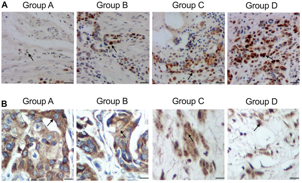Distinct level of cellular apoptosis in colon cancer tissue samples with distinct genotypes and methylation levels of KCNQ1OT1 promoters (scale bar: 25 μm). (A) Increased expression of ATG4B protein in group A: carrier of allele 10 + methylated, B: carrier of allele 10 + non-methylated, C: non-carrier of allele 10 + methylated, D: non-carrier of allele 10 + non-methylated. (B) Decreased apoptosis in group A: carrier of allele 10 + methylated, B: carrier of allele 10 + non-methylated, C non-carrier of allele 10 + methylated, D: non-carrier of allele 10 + non-methylated.