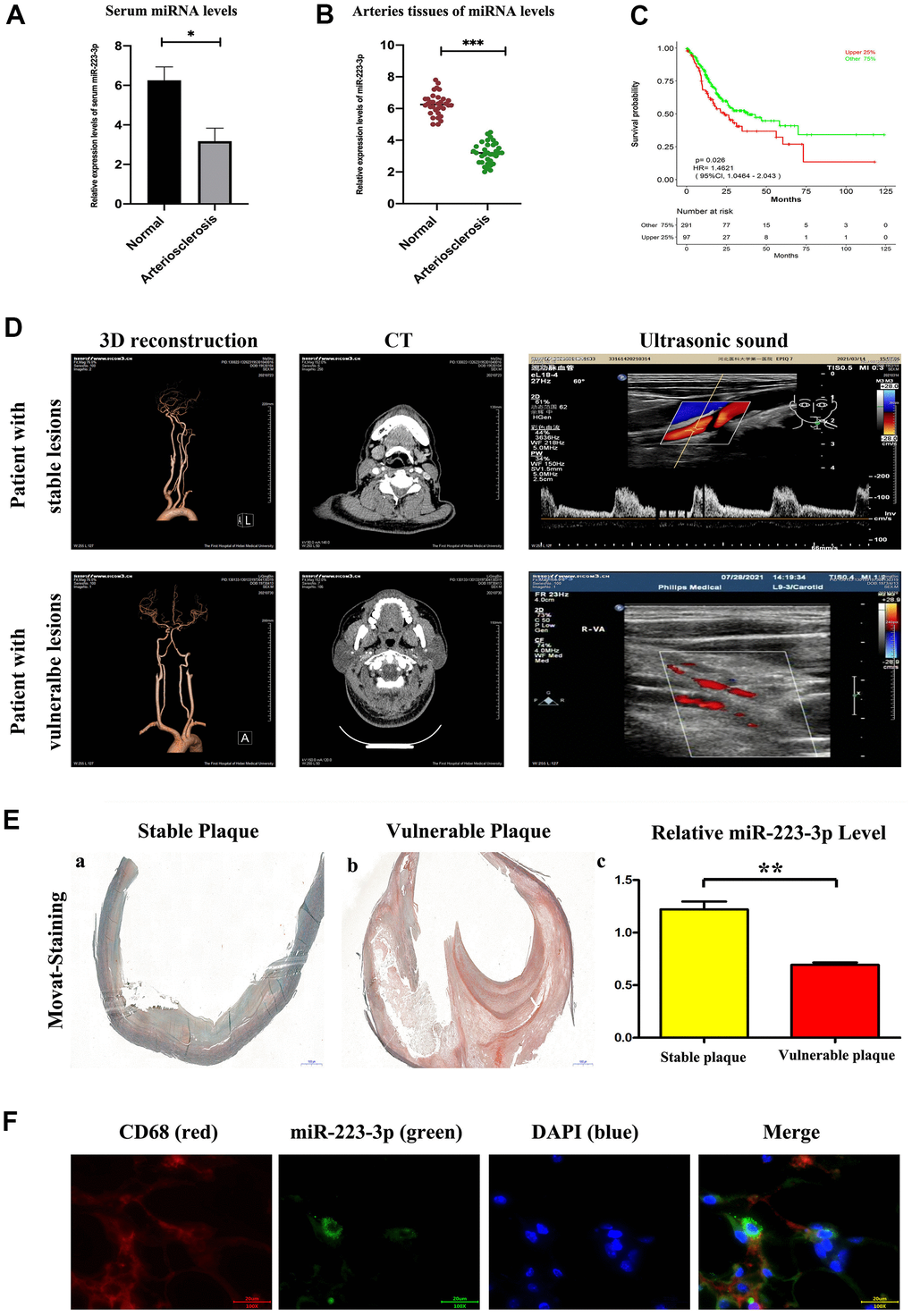 Enhanced miR-223-3p levels in carotid arteries and serum from patients with AS. (A) The levels of miR-223-3p were higher in AS arteries as compared with normal arteries determined by qPCR. (*PB) The levels of miR-223-3p were higher in the serum of AS patients compared with normal controls determined by qPCR. (*PC) The expression level of miR-223-3p has been associated with a higher overall survival rate by ROC curve. (D) The three-dimensional vascular remodeling, CT, ultrasonic sound pictures from patient with stable or vulnerable lesions were shown. (E) Histological analysis on the aortic sections evaluates the morphological differences by Movat staining. Representative staining results for vulnerable plaque and stable plaque. Decreased miR-223-3p in the vulnerable plaque as compared with stable plaque (*PF) Fluorescent In Situ Hybridization assay revealed miR-223-3p (green) co-localization with CD68+ (red) macrophages in vulnerable atherosclerotic lesions of AS patients. DAPI (blue) for nuclei staining.