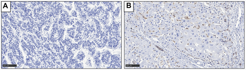 Representative IHC staining result to show the expression of Gal-9 in HCC tissues. (A) Negative Gal-9 expression; (B) Positive Gal-9 expression.