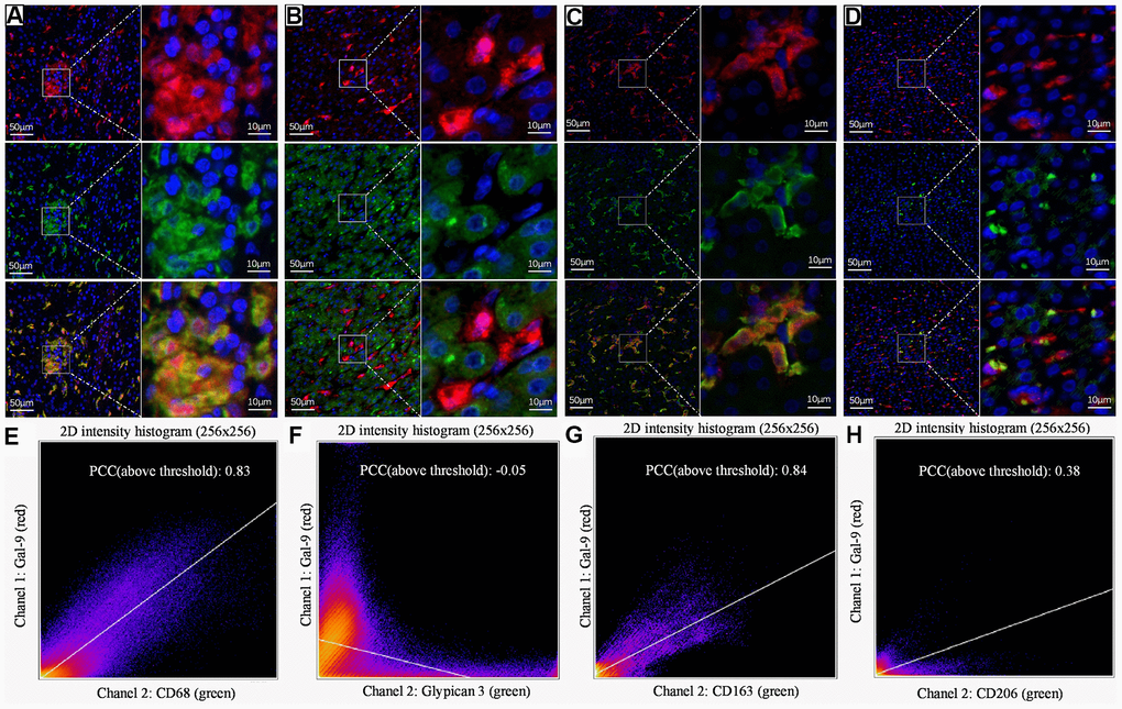 Representative dual IF staining result to show the colocalization of Gal-9 with different cell markers. Dual-IF staining of Gal-9 and CD68 (A), Gal-9 and GPC3 (B), Gal-9 and CD163 (C), Gal-9 and CD206 (D). (blue: nuclei; red: Gal-9; green: CD68/GPC3/CD163/CD206; yellow: merge). Quantitation of the colocalization of Gal-9 and CD68/GPC3/CD163/CD206 is shown in (E–H). PCCs (above threshold) of Gal-9 and CD68/GPC3/CD163/CD206 were 0.83, -0.05, 0.84 and 0.38, respectively. Results showed that Gal-9 was mostly expressed on CD68+CD163+ KCs, but not HCC tumor cells or M2 macrophages. Scale bar, 50μm (left column) and 10μm (right column).