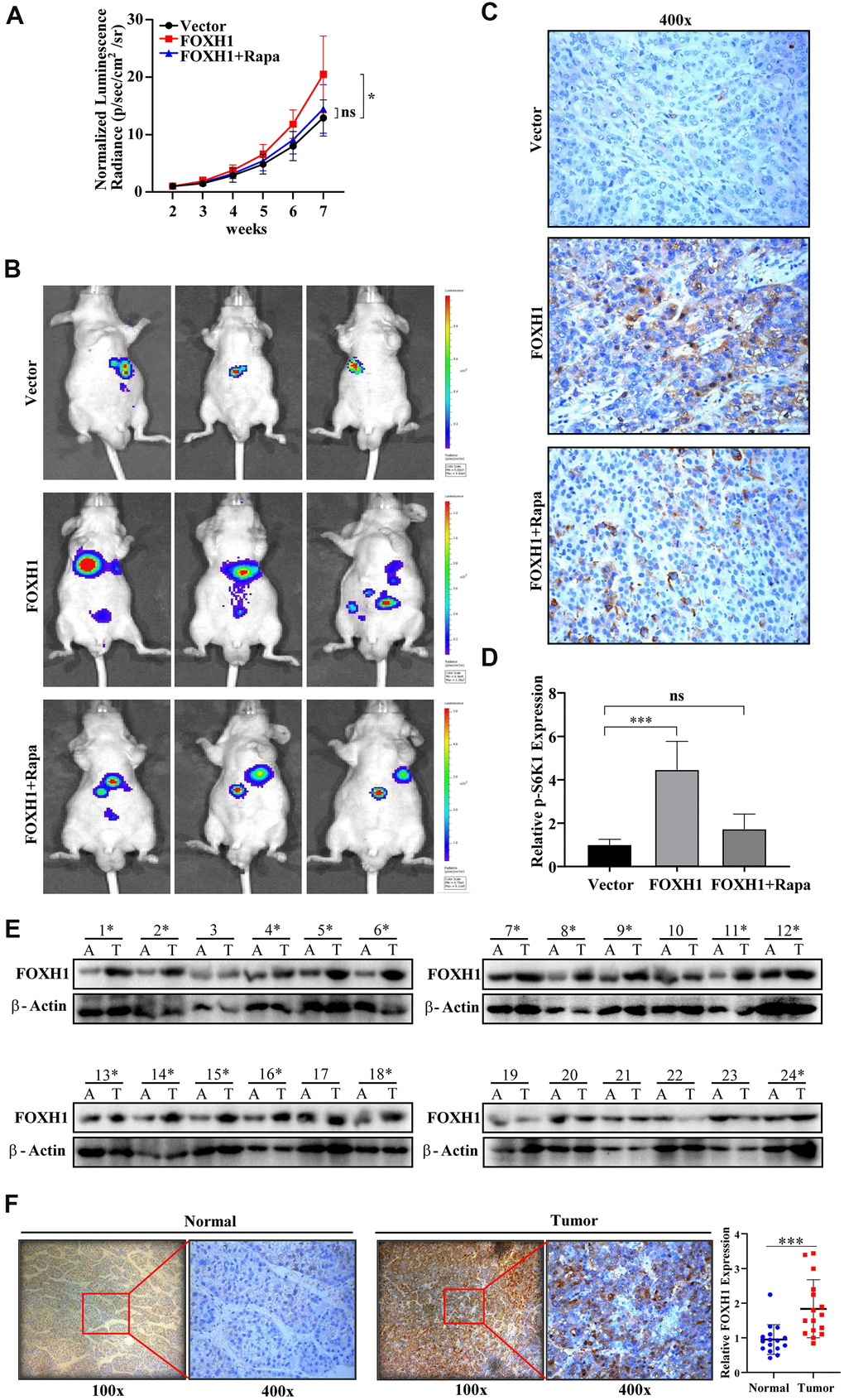 In vivo and clinical evidence confirmed the oncogenic role of FOXH1 in HCC development. (A) The HA22T tumor growth curve. (B) Representative images of HA22T tumors. (C) p-S6K1 staining showed that FOXH1 promoted HA22T tumor growth was dependent of mTOR activation. (D) A statistical analysis of p-S6K1 level. (E) Western blotting analysis of FOXH1 in 24 HCC samples with their paired adjacent liver tissues. (F) IHC staining of FOXH1 in HCC samples using their corresponding adjacent liver tissues as controls. Left, representative image of FOXH1 staining in slides made from patient 1#. Right, statistical analysis of FOXH1 staining. Scale bar: 25 μm. *P