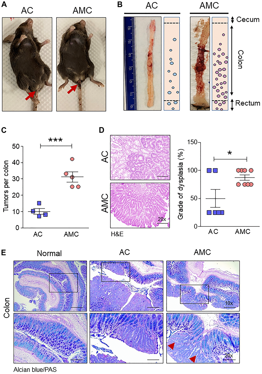 Muc4 deletion drives colorectal tumors with high-grade dysplasia and goblet cell dysfunction. (A) Representative images of AC and AMC animals had typical rectal bleeding. (B, C) Muc4-/- mice in the AMC group showed an increase in the number of macroscopic polyps in the colon and rectal region. n =4-5 per group. (D) H&E staining of AMC animals had a higher grade of dysplasia. n = 6-8 per group. (E) Representative images of double staining of Alcian blue and PAS. n = 6 (AC and AMC) and n=3 for normal group. Red arrowhead indicates loss of mucins expression in the goblet cells in AMC mice. *p p 