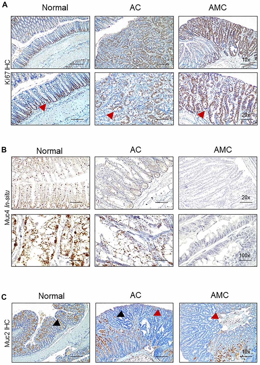Absence of Muc4 alters other mucins expression. (A) Immunohistochemistry staining of Ki67 in the colon of normal, AC, and AMC mice. Red arrowhead indicates Ki67 staining restricts to crypts in normal animals, whereas AMC mice showed higher cell proliferation (more Ki-67 staining), which might be attributable to colonic crypt hyperplasia. (B) Staining of Muc4 was observed in normal, AC mice, whereas the complete absence of Muc4 expression in AMC animals was performed by in-situ hybridization. (C) Immunohistochemistry staining of Muc2 (Black arrowhead: positive staining and Red arrowhead: absence of staining in the tumors). n = 6 (AC and AMC) and n=3 for normal group.
