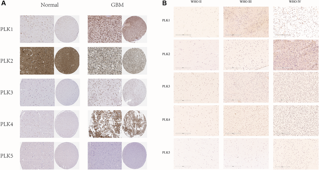 (A) IHC illustration of PLK expression levels in GBM (HPA). (B) Immunohistochemical staining of PLKs in gliomas.