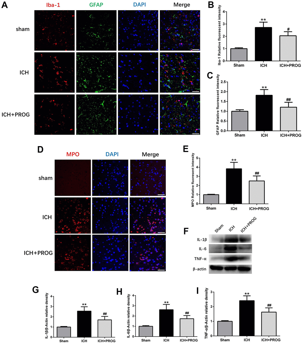 Effect of progesterone on the activation of microglial and astrocyte, neutrophil infiltration, neuroinflammation. (A) Representative immunofluorescence staining images of Iba-1(red) and GFAP (green) in perihematomal region. Nuclei were counterstained with DAPI (blue). Bar=50μm. (B, C) Quantitative analyses of Iba-1 and GFAP relative fluorescent intensity in perihematomal region in each group. (D) Representative immunofluorescence staining images of MPO (red) in perihematomal region. Nuclei were counterstained with DAPI (blue). Bar=50μm. (E) Quantitative analyses of MPO relative fluorescent intensity in perihematomal region in each group. (F) Representative Western bands showing the protein expression of IL-1β, IL-6, TNF-α in perihematomal region. (G–I) Quantitative analysis of Western blots shows that the expression of IL-1β, IL-6, TNF-α changes in each group. n = 6 animals per group. Data are expressed as the mean ± SEM; **P #P ##P 