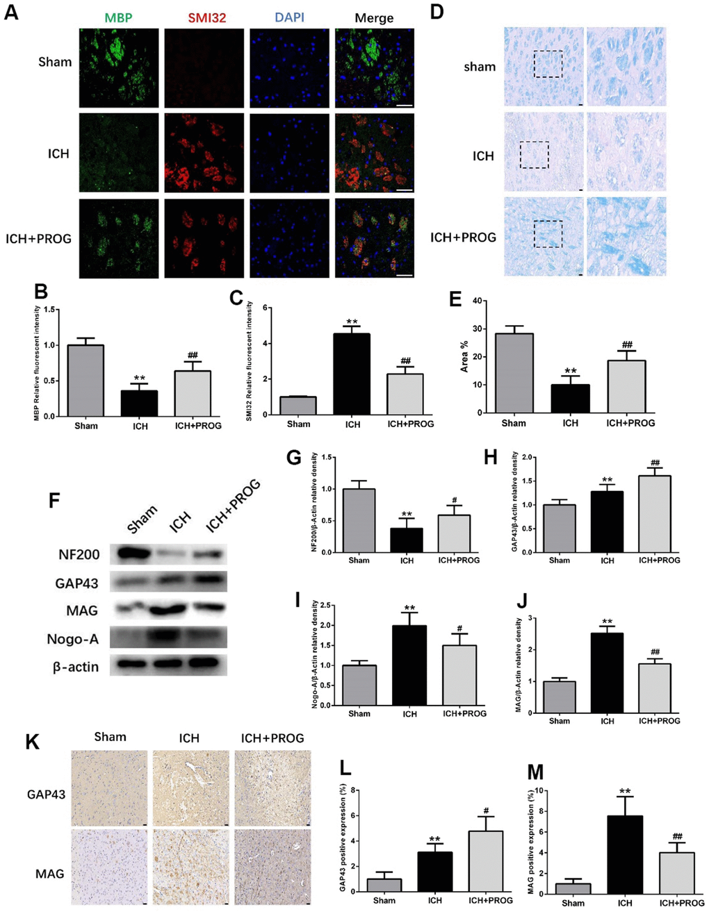 Effect of progesterone on myelin loss and axonal pathology. (A) Representative immunofluorescence staining images of MBP (green) and SMI32(red)in perihematomal region. Nuclei were counterstained with DAPI (blue). Bar=50μm. (B, C) Quantitative analyses of MBP and SMI32 relative fluorescent intensity in perihematomal region in each group. (D) Representative images of Luxol fast blue staining. Bar=50μm. (E) Quantitative analyses of positive stained myelin ratio in each group. (F) Representative Western bands showing the protein expression of NF200, GAP43, Nogo-A and MAG in perihematomal region. (G–J) Quantitative analysis of Western blots shows that the expression of NF200, GAP43, Nogo-A and MAG changes in each group. (K) Representative images of immunohistochemistry staining of GAP43 and MAG in perihematomal region. Bar=50μm. (L, M) Quantitative analyses of GAP43 and MAG positive expression in perihematomal region in each group. n = 6 animals per group. Data are expressed as the mean ± SEM; **P #P ##P 