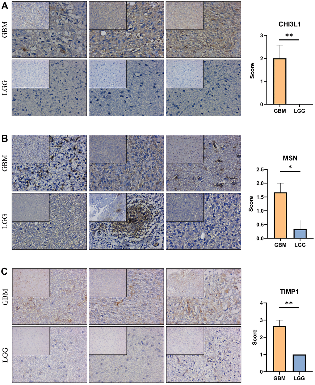 Expression verification of the prognostic genes. (A–C) Immunohistochemical staining analysis of the protein levels of CHI3L1, MSN and TIMP1 between the low-grade and high-grade gliomas. *, P