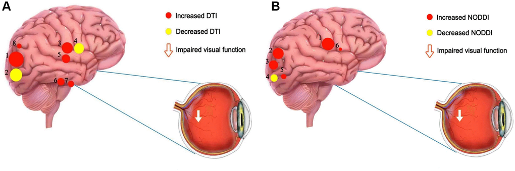 The mean DTI and NODOI values of altered brain regions. (A) Compared with the HCs, the DTI values of the following regions were decreased to various extents: 2- left superior longitudinal fasciculus (FA) (t = −6.78), 4- body of corpus callosum (FA) (t = −6.25). Compared with the HCs, the DTI values of the following regions were increased to various extents: 1- left superior longitudinal fasciculus (MD) (t =7.61), 7- right posterior limb of internal capsule (MD) (t = 5.31), 8- right posterior thalamic radiation (MD) (t = 4.94), 3- genu of corpus callosum (AD) (t = 6.37), 6- right posterior limb of internal capsule (AD) (t = 5.36), 5- right splenium of corpus callosum (AD) (t = 5.47). (B) Compared with the HCs, the NODOI values of the following regions were increased to various extents: 2- left anterior corona radiata (t = 5.17), 6- body of corpus callosum (t = 4.18), 5- left superior longitudinal fasciculus (ODI) (t = 4.54), 1- right splenium of corpus callosum (t = 6.86), 3- left posterior corona radiata (t = 5.03). Compared with the HCs, the NODOI values of the following regions were decreased to various extents: 4- left superior longitudinal fasciculus (FICVF) (t = −4.56). Abbreviations: HCs: healthy controls; DTI: diffusion tensor imaging; FA: fractional anisotropy; MD: mean diffusivity; AD: axial diffusivity; ODI: orientation dispersion index; FISO: isotropic volume fraction; FICVF: intracellular volume fraction.
