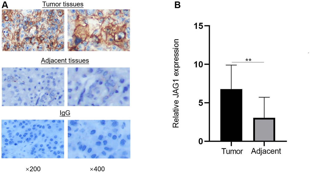 JAG1 is overexpressed in HCC tissues. (A) Immunohistochemistry showed the expression of JAG1 in HCC and adjacent tissues. (B) The expression level of JAG1 was significantly higher in HCC tissues than in adjacent tissues. **p 
