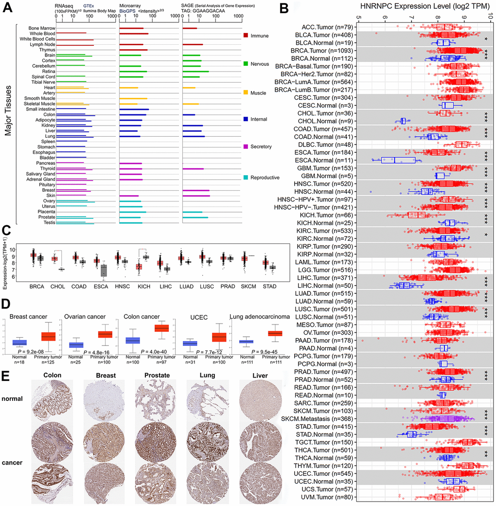 HNRNPC expression in different tumor type. (A) The expression levels of the HNRNPC gene varies according to tumor type. in GTEx, Illumina, BioGPS, and SAGE. (B) TIMER2 was used to determine the amount of expression of the HNRNPC gene in various malignancies or particular cancer subtypes. (C) The TCGA project provided box plot data for pan-cancer, as well as normal tissues from the GTEx database as controls. (D) The expression level of HNRNPC total protein was determined in normal and primary tissues using the CPTAC dataset. (E) HPA-induced expression of the HNRNPC protein in tumor and tumor-adjacent normal tissues. * P 