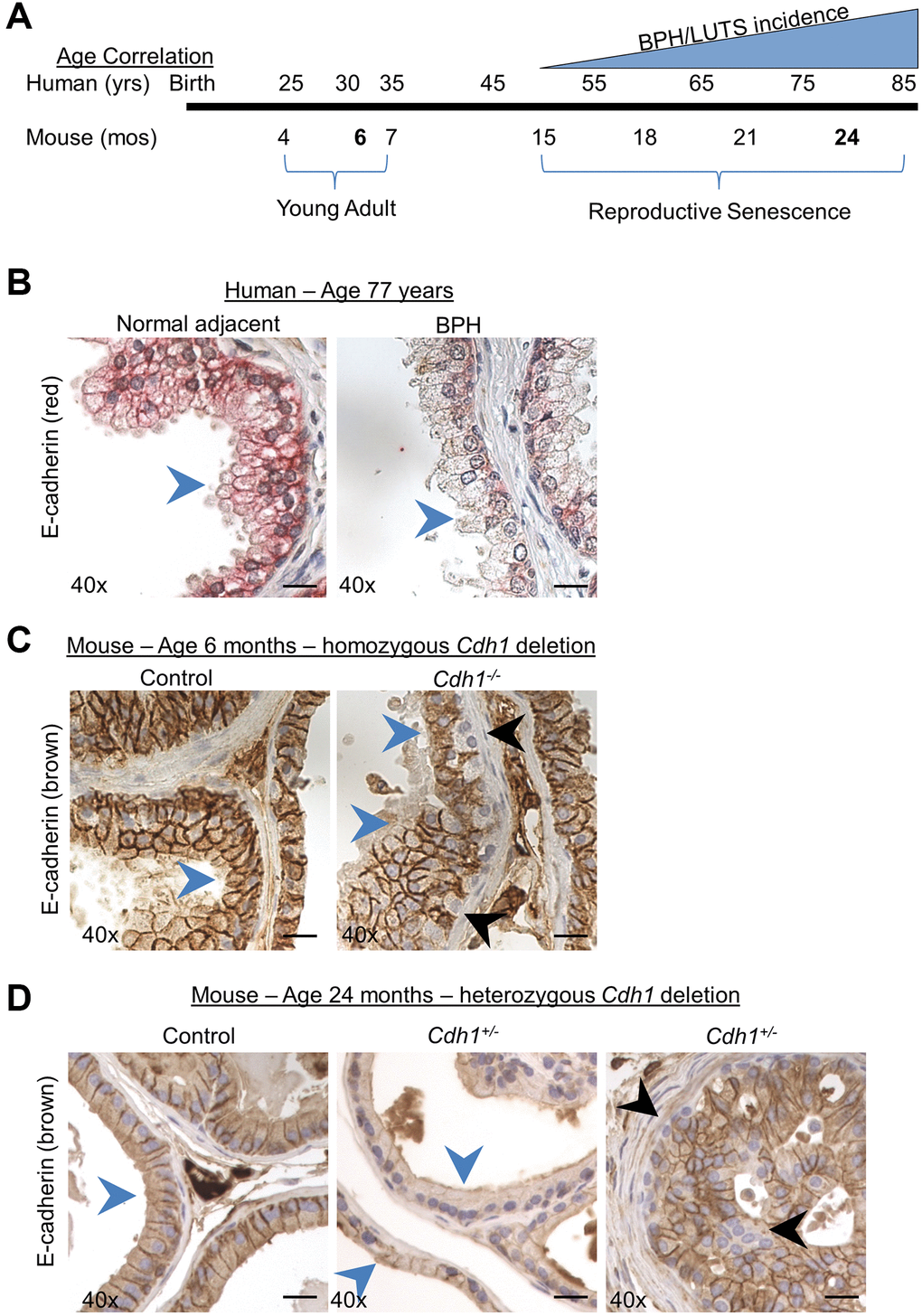 Modeling the combined impact of heterozygous E-cadherin loss and aging on the murine prostate. (A) Correlation of human age and BPH/LUTS incidence to aging of C57BL/6 mice [18]. Experimental timepoints for mice at 6 months and 24 months of age (noted in bold) correlate to 30 years and 75–85 years of age for men. (B) Representative E-cadherin immunostaining (red) in normal prostate adjacent to BPH (left) and in glandular BPH (right) specimens from a 77-year-old patient. (C) E-cadherin immunostaining (brown) in Control (left) and mice with homozygous deletion of E-cadherin (Cdh1-/-) (right) mouse ventral prostate at 6 months of age. E-cadherin immunostaining in Cdh1-/- mice displayed a mosaic pattern of E-cadherin negative cells (black arrows) surrounded by a layer of E-cadherin positive epithelial cells (blue arrows). (D) E-cadherin immunostaining in Control (left) and mice with heterozygous deletion of E-cadherin (Cdh1+/-) mouse ventral prostate (center showing apparent reduced E-cadherin immunostaining, and right panel showing mosaic staining pattern) at 24 months of age. Blue arrows indicate epithelial cells with positive E-cadherin staining, black arrow indicates E-cadherin negative epithelial cells. Original magnification, 40×. Scale bars indicate 25 μm.