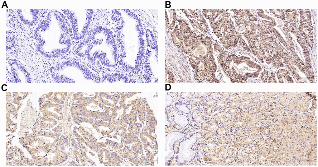 Immunohistochemical expression of Nrf2 and heme oxygenase-1 (HO-1) in gastric cancer (GC) and para-carcinoma tissues. (A) Slides without primary antibody served as the negative control in GC tissues. (B) Typical immunohistologic features with Nrf2 expression in GC tissues. The Nrf2 staining localized predominantly in the nucleus. (C) Typical immunohistologic features with HO-1 expression in GC tissues. (D) Typical immunohistologic features with Nrf2 expression in para-carcinoma tissues. Magnifications, ×200.