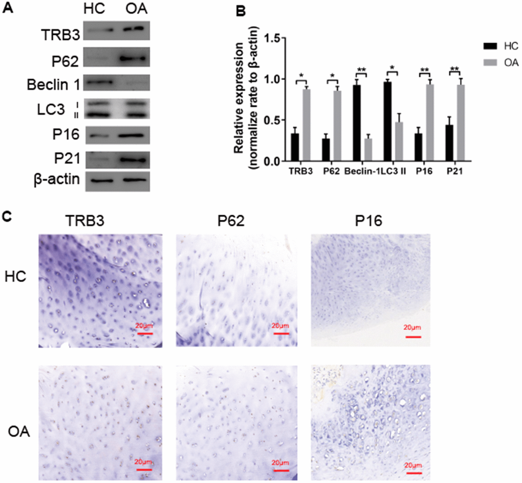 TRB3 is increased in human and knee articular cartilage. (A, B) Blots were stripped and reprobed with β-actin as a loading control. Densitometric analysis for protein levels of TRB3, P62, P16, P21, Beclin and LC3B. (C) Articular cartilage sections of HC or OA were analyzed immunohistochemically for TRB3, P62, and P16. The results are described as the mean ± SD. *P 