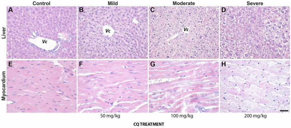 The lower dose of 50 mg/kg CQ did not cause significant pathological changes in the liver and the heart. (upper panel): Pathological changes in the liver of controls (A) and treatment (50 mg/kg) (B–D) consisted of hydropic degeneration and hepatocyte necrosis. The changes were visible mostly in portal areas and as they became more advanced, they spread through the lobule. Fibrosis and mononuclear inflammatory infiltrates were also present on occasion in portal spaces. (lower panel): In the heart of controls (E) and treatment (50 mg/kg) (F–H), interstitial oedema, intercalate disks fragmentation, loss of myocardiocyte striations and even areal necrosis could be seen, more frequent and more intense with increasing treatment dosage. Abbreviation: Vc, central vein. N = 10 for each group.
