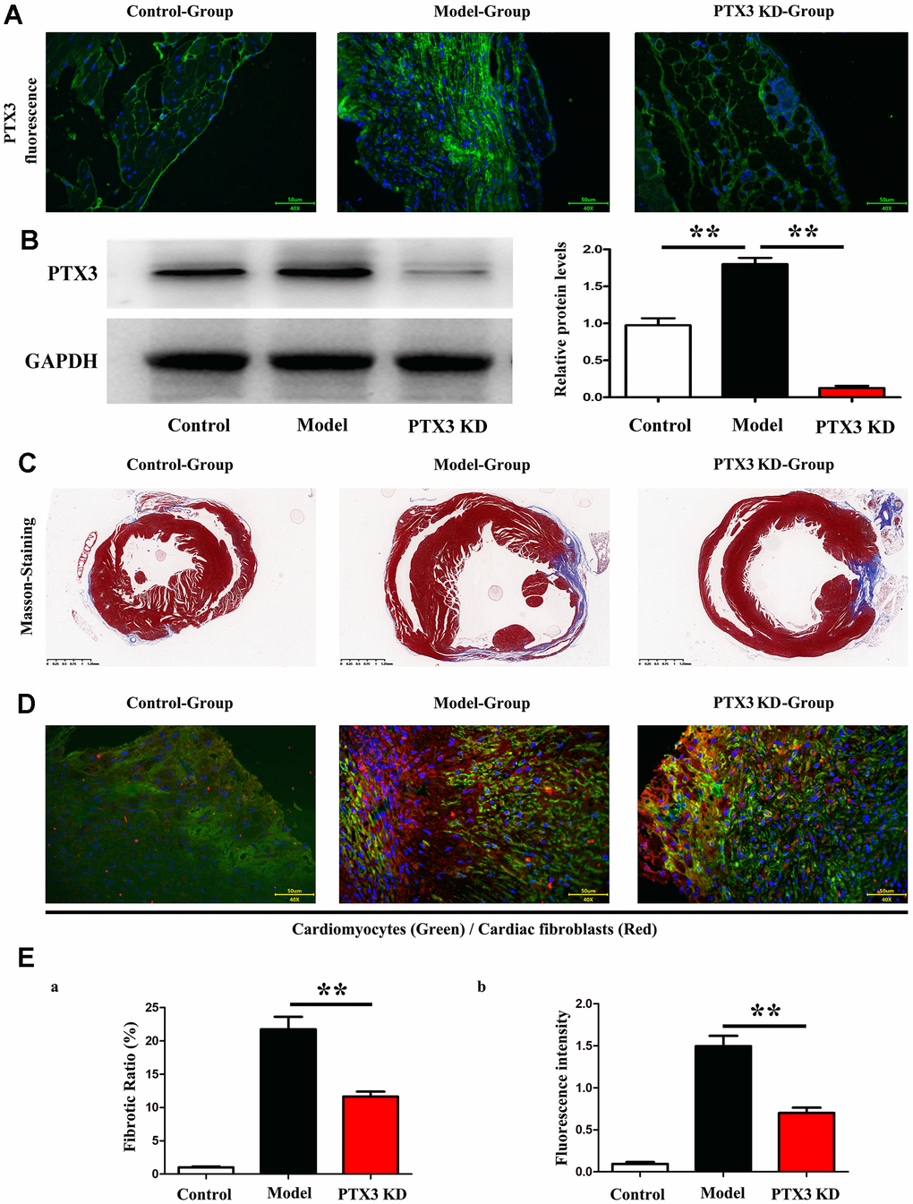 PTX3 KD counteracted myocardial fibrosis by down-regulating IL-6/STAT3 pathway in murine HF after MI. (A) Representative Masson staining images in each group. (B) The fibrosis ratio was quantified by the percentage of interstitial fibrosis in the total LV area in Masson staining and expressed as the average of all sections. (C) Representative IF counterstaining images in each group (×40). Cardiomyocytes were stained with cardiac troponin T (green) and cardiac fibroblasts were stained with α-SMA (red). (D) Fluorescence intensity of α-SMA was quantified. (E) Western blotting was performed to measure the protein expression. Control group vs. PTX3-NC group, *ppp#p##p###p