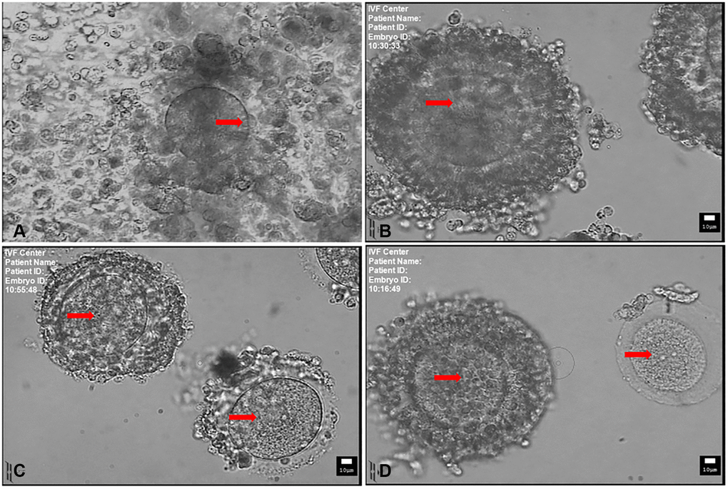 Mature and immature oocytes collected at the time of retrieval. (A) MII-stage oocyte with a disperse cumulus cells surrounding. Arrow indicates the first polar body. (B) Immature oocyte with compacting cumulus cells. (C) Immature oocyte with sparse cumulus cells. (D) Immature oocyte with compact (left) and denuded cumulus cells (right). Arrow indicates the germinal vesicle in (B, C and D). Scale bar: 10 μm.