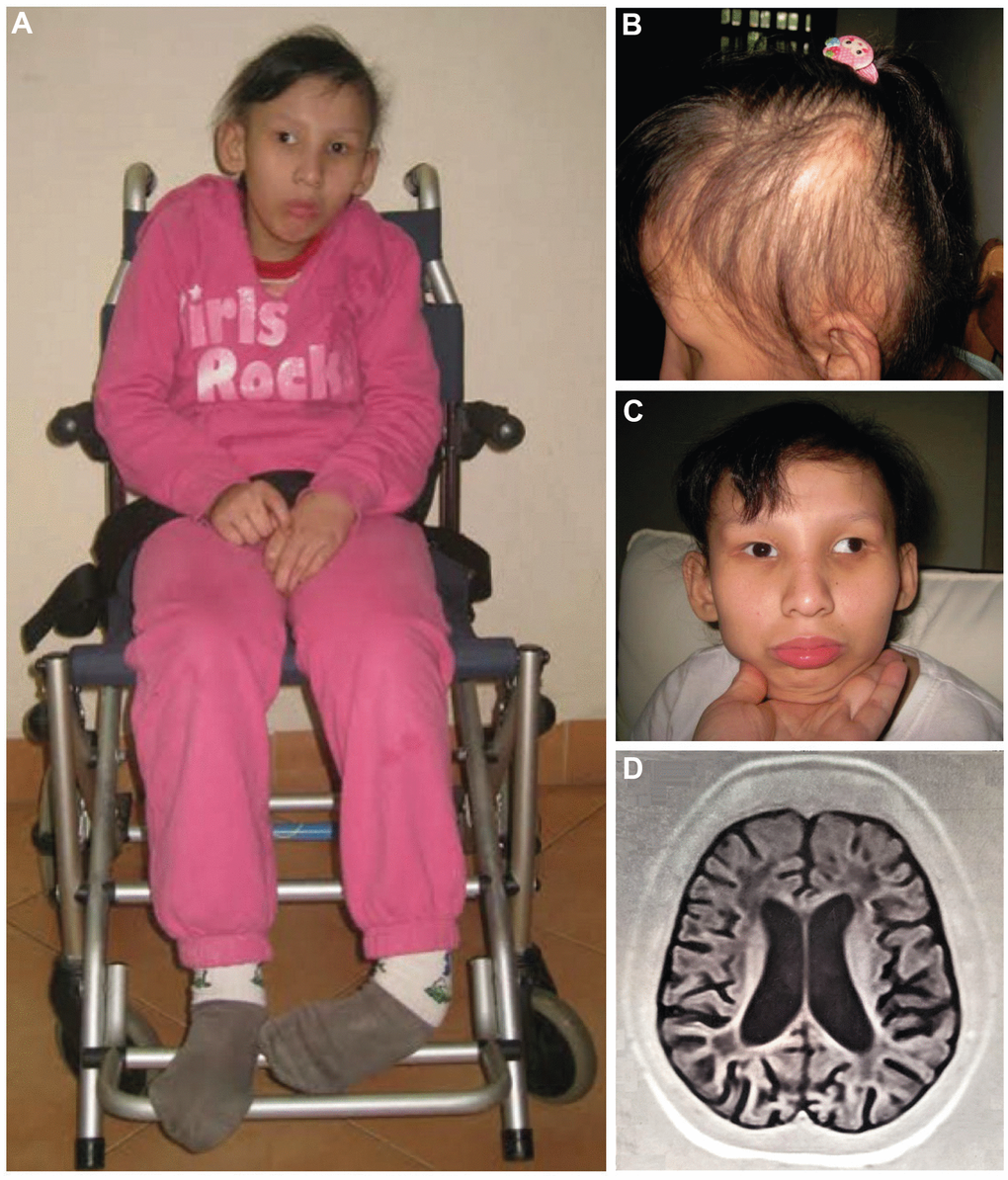 Proband at the age of 16 (A–C): (A) Full length figure of the proband, thinning hair (B) and strabismus at front vision (C) were observed. Brain T1-weighted MRI image at the age of 14 years (D).