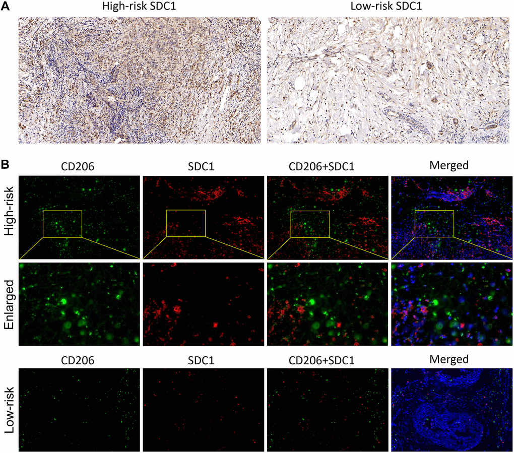 The SDC1 expression features in BC samples. (A) The IHC assay showed the SDC1 expression level in the high-risk and low-risk patients. (B) The IF assay verified the SDC1 and CD206 expression levels, as well as their co-expression in the high-risk and low-risk patients. CD206, green; SDC1, red; DAPI, nucleus.