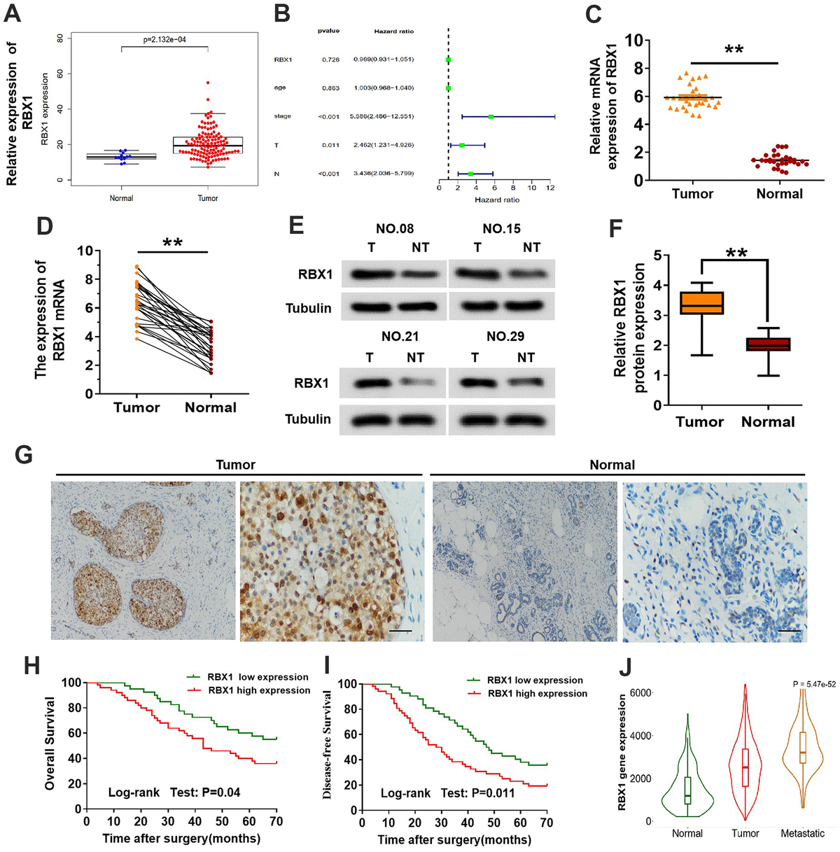 e3-ubiquitin-ligase-rbx1-drives-the-metastasis-of-triple-negative