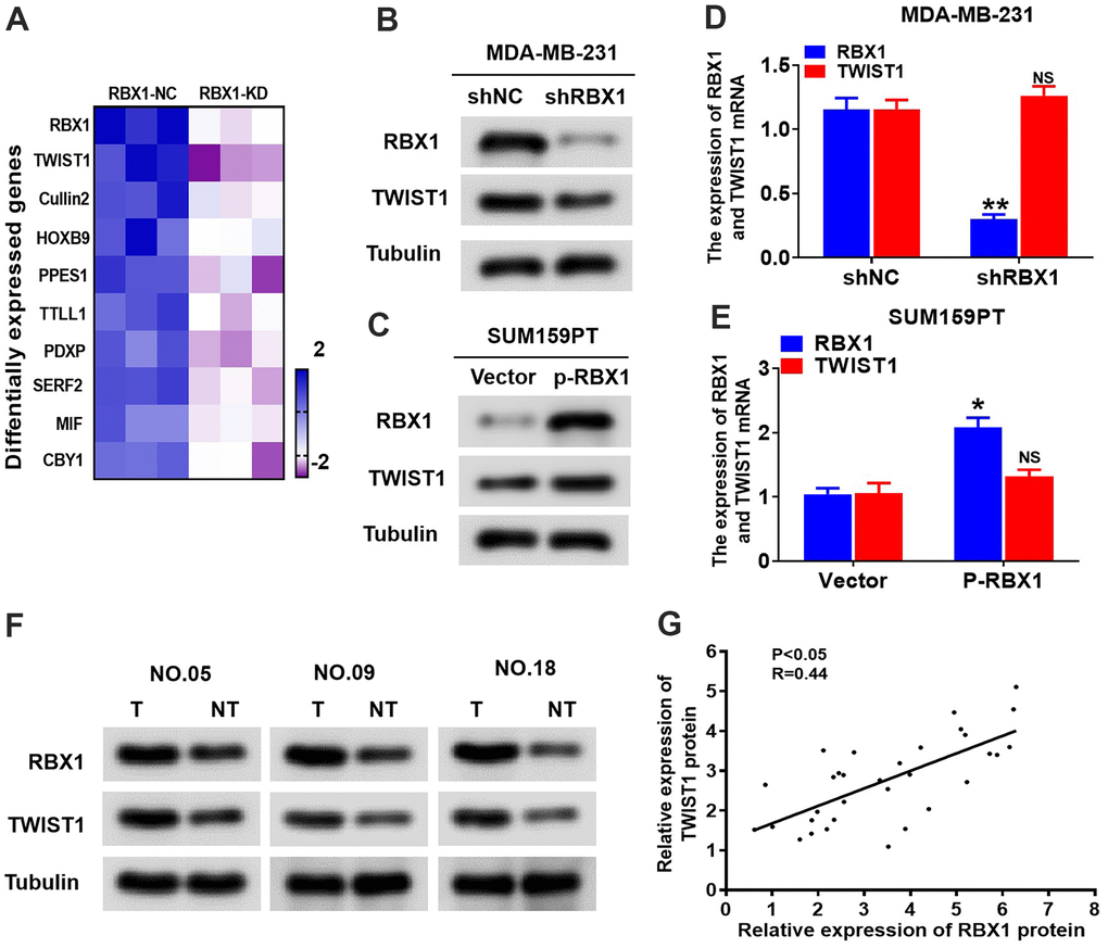 RBX1 positively regulates the TWIST1 protein levels. (A) Heatmap confirms the genes with 2-fold or more change in protein levels between the MDA-MB-231 cells with knockdown of RBX1. (B, D) The qRT-PCR and western blotting assay of the expression levels of TWIST1 in MDA-MB-231 cells stably transfected by shRBX1 or shNC plasmids. **P C, E) The qRT-PCR and western blotting assay of the expression levels of TWIST1 in SUM159PT cells stably transfected by vector or plasmid with overexpression of RBX1. *P F) Western blotting was applied for detecting the levels of TWIST1 and RBX1 protein in TNBC cancer tissues together with paired non-tumour tissues, 30 numbers in each group. Tubulin was utilized as a loading control. (G) Scatter plots of TWIST1 and RBX1 protein expression in the TNBC.