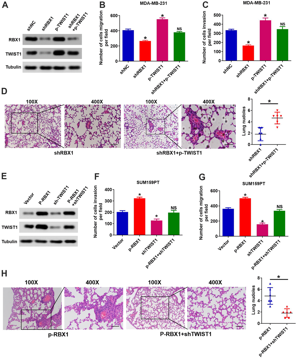 RBX1 facilitates TNBC metastasis and invasion via raising the expression of TWIST1. (A) The expression of TWIST1 and RBX1 was measured with western blotting. The raise of TWIST1 reduced the expression of TWIST1 in MDA-MB-231-shRBX1 cells. (B, C) Transwell analysis suggested that the increase of TWIST1 markedly rescued the cell invasion and migration in the MDA-MB-231-shRBX1 cells (*PD) H&E staining of sections embedded with paraffin of metastatic nodules in the lung. *P E) Western blotting was applied for measuring the levels of TWIST1 and RBX1 protein. The TWIST1 expression knockdown greatly suppressed the raise in the expression of TWIST1 in SUM159PT-p-RBX1 cells. (F, G) Transwell analysis displayed that TWIST1 suppression attenuated RBX1-enhanced cell invasion and migration. *P H) H&E staining of sections embedded with paraffin of metastatic nodules in the lung. * P 