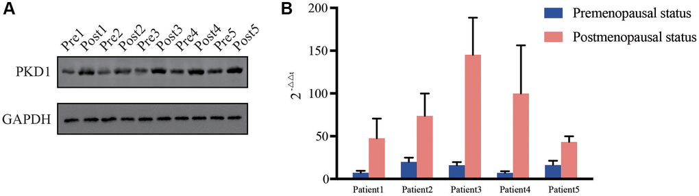 Relative expression of PKD1 in 5 pairs of pre- and post-menopausal patients in our center for (A) protein level and (B) RNA level. Pre, premenopausal status, Post, postmenopausal status.