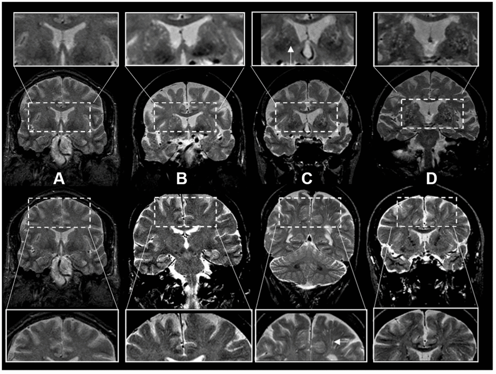 Enlarged perivascular space burden using ratings in coronal T2-weighted MRI sequences. *Top rows: basal ganglia region. Bottom rows: centrum semiovale region. The inserts represent a closer view. White arrows point to individual examples of enlarged perivascular spaces (panel C inserts). †Grades of ePVS burden are based on T2 weighted coronal views. (A) Grade I (0-10), (B) Grade II (10-20) (C) Grade III (20-40) (D) Grade IV (40+).
