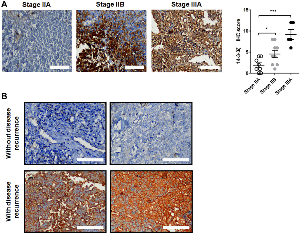 Expression of 14-3-3ζ protein in surgical resected NSCLC samples. (A) Representative IHC staining of 14-3-3ζ protein in NSCLC tissues at different clinical stage. The IHC score of 14-3-3ζ in each group was analyzed (*P ***P B) Representative IHC images of 14-3-3ζ protein in patients without (upper panel) and with (lower panel) disease recurrence. Scale bar = 200 μm.